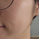 전주피부관리 / 새싹뷰티 에서 슈퍼젝션 2회차 받고 비포 애프터 비교 후기