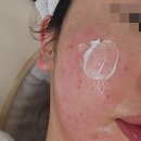 영인 | 방화동피부관리 영인피부에서 여드름피부 관리 받은 후기