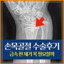 손목 골절 수술 후기 금속 핀 제거 꼭 필요할까 비용과 시기는?