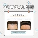 동탄대로1길 | 동탄 모발이식 후기 볼 때 중요하게 볼 부분은