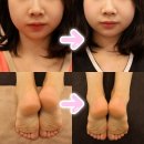 성인 척추측만증 안면비대칭 교정 후기 가격, 카이로테라피