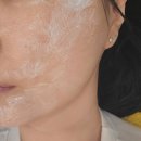 스킨풀 | 강남역피부과 스킨보톡스 풀페이스 후기