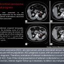 Adrenal cortical carcinoma 이미지