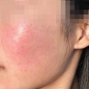오로라피부관리실 | 홍조 뷰티 디바이스 오로라 더마샷 내돈내산 불타는 고구마 피부 탈출한 후기