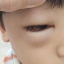 청진식품 | 들깨 알레르기 아주대 외래에서 진단받은 후기