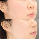 아이디병원 | 얼굴 붉은기 피부 장벽 강화 민감성 재생 진정 추천 아이디 엑소좀 앰플 후기