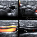 reverberation artifact mimicking carotid plaque 이미지