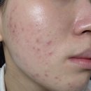 아젤리아 | 여드름 탈출기 : 아젤리아 크림 후기