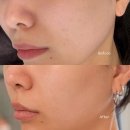 이상경 | 홍대피부과 볼뉴머600샷 내돈내산 후기｜10일 동안 직접 기록한 피부 변화 (모공·탄력·속건조)