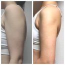 신사-102 | 신사 팔뚝 지방추출주사 후기 - 추천하는 이유