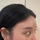 강남역 젤성형외과 30대 이마거상술 후기