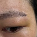 초이성형외과 | [병원] 논현역 ㅊㅇ성형외과 피부 양성종양, 얼굴 혹, 20대 눈꺼풀 모기질종 수술 후기 1탄