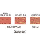 횡문근육종 (Rhabdomyosarcoma) 이미지