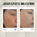5844 | 주근깨 피부톤 관리 <JB뷰티라운지> 트라이엄에너지케어 받은 후기