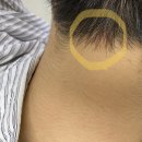 담대한외과의원 | 광주 담대한외과 피지낭종 수술 후기
