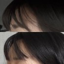 조은날뷰티 | 강남 이마필러 후기｜신논현피부과 뉴라미스 3cc 전후사진 및 2주차 경과