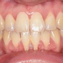 덴탈플란트 이미지