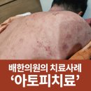 순천 배한의원 아토피 치료 후기, 침치료와 4DF 피부관리