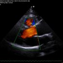 심장-선천성 이첨 대동맥판(congenital bicuspid Aortic valve) 이미지