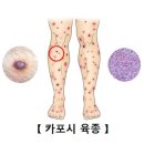 카포시 육종[Kaposi's sarcoma]종양혈액질환 이미지