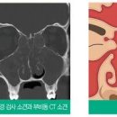 급성 만성 부비동염 및 원인, 축농증 (약, 두통, 노란콧물) 이미지