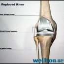 무릎연골수술//인공관절치환술 시기//무릎연골수술//인공관절치환술 시기 이미지