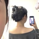 오모야 | 버섯증후군 치료로 버섯목 유스키니 시술 받은 1차 후기