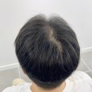 헤어증모하다 | 웨딩촬영 남자 헤어 종류｜한올 증모술 후 펌·염색 볼륨 가능했던 후기