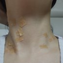 연세유의원 | 편평사마귀 목 제거(응암역 피부과)