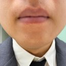 서울 중구 해피메디의원 제모 듀에또 내돈내산 후기[8]