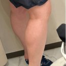 유라인 지방분해주사 종아리컷주사 후기