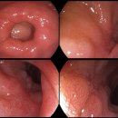 십이지장궤양[duodenal ulcer] 이미지