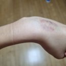 굴포천경희 한의원 | 손목결절종 치료 후기 / 손목결절종 호전 / 손목결절종 한의원 / 손목 혹 치료