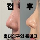 홍대입구역 폼미코 + 로리앙 필러 : 코끝 + 날렵한 라인 코 리프팅 내돈내산 성공 후기