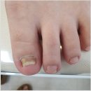 세종발톱무좀 프리미엄 발관리샵 방문 발데렐라 // 내성발톱 무좀발톱 발각질