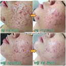 바디닥터 서구내당점 | 운동하는 남자 여자 여드름 여드름압출 잘하는곳 대구 달서구 뷰티일로