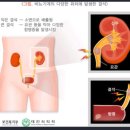 요로결석진단비보장 특별약관 이미지