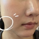 300 | 울쎄라 300샷 후기. 울쎄라피프라임 울쎄라프라임 효과