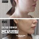 희성전자 대구2공장 | 대구 온다리프팅 이중턱 심부볼 제거 전후효과 솔직후기