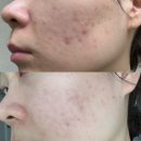 공덕제일약국 | 공덕피부과 플라듀오 여드름 레이저 및 압출 10일차 후기