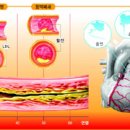 혈관에 쌓인 중성지방 ‘몸은 울고 싶다’ 이미지