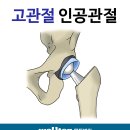 [고관절 치료]고관절 통증은 어떻게 치료해야될까요? 이미지