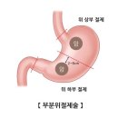 신드롬(syndrome)