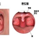 목젖 염증 증상 나타날 때 커큐민 영양제 찾는 이유 이미지