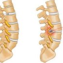 허리디스크 증상 원인 치료 이미지