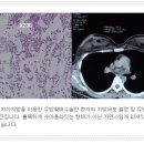 보형물 가슴성형 vs 자가지방 가슴성형 이미지