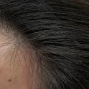 채움주유소 | 영등포 두피관리/ 모다스튜디오에서 M자 헤어라인 교정 받은 후기