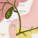 담낭염 증상 원인 담낭염 치료 담낭염에 좋은 음식 이미지