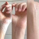 팔 모공각화증 각질 극복한 후기