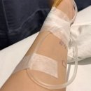 난소 혹 4.5cm 제거 복강경 수술 후기 2 (수술 후 4주, 난소종양, 골반 자궁내막증, 로렐린 데포주사 1...